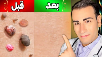 از بین بردن یک روزه زگیل و منگوله های پوستی در خانه