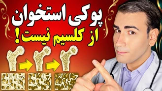 پوکی استخوان از کمبود کلسیم نیست! پیشگیری و درمان