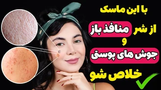 آموزش آرایش / ماسک صورت ضد جوش ضد چروک و از بین برنده منافذ باز 
